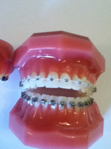 für Keramik brackets Love it für Metall hate it ;/ für Keramik brackets Love it für Metall hate it ;/