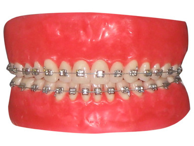 welche brackets die ersten beiden brauchen ca 2jahre die untere 2 1/2 jahre