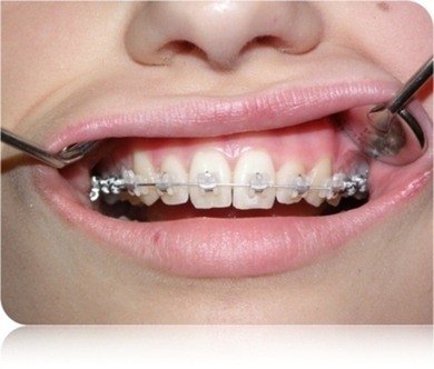 welche brackets die ersten beiden brauchen ca 2jahre die untere 2 1/2 jahre