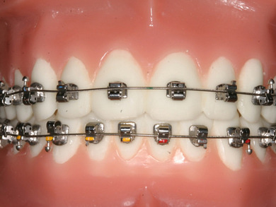 welche brackets die ersten beiden brauchen ca 2jahre die untere 2 1/2 jahre