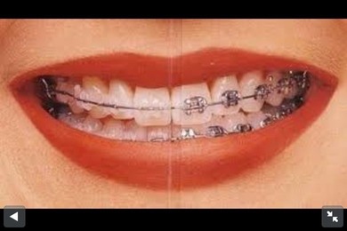 ich brauche ganz dringend Hilfe ich weißt nicht ob ich Keramik brackets (rechts) oder normale brackets (links) nehmen soll bitte Love it wenn ihr für normal seit und hate it für Keramik und ein kommi wäre Super nett danke :) ich brauche ganz dringend Hilfe ich weißt nicht ob ich Keramik brackets (rechts) oder normale brackets (links) nehmen soll bitte Love it wenn ihr für normal seit und hate it für Keramik und ein kommi wäre Super nett danke :)