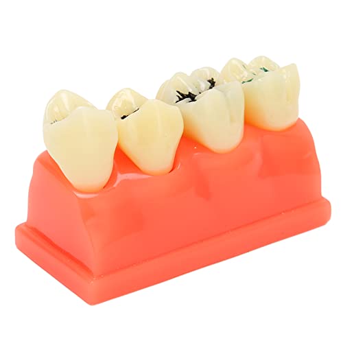 Zahnkariesmodell, Simulator Mannequin Harz 4 Zähne Oral Care Educational Karies-Zahn-Display-Modell für Zahnklinik von ANGGREK