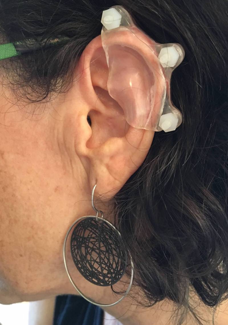 Ohr Keloid Benutzerdefinierte Compression von Earpress