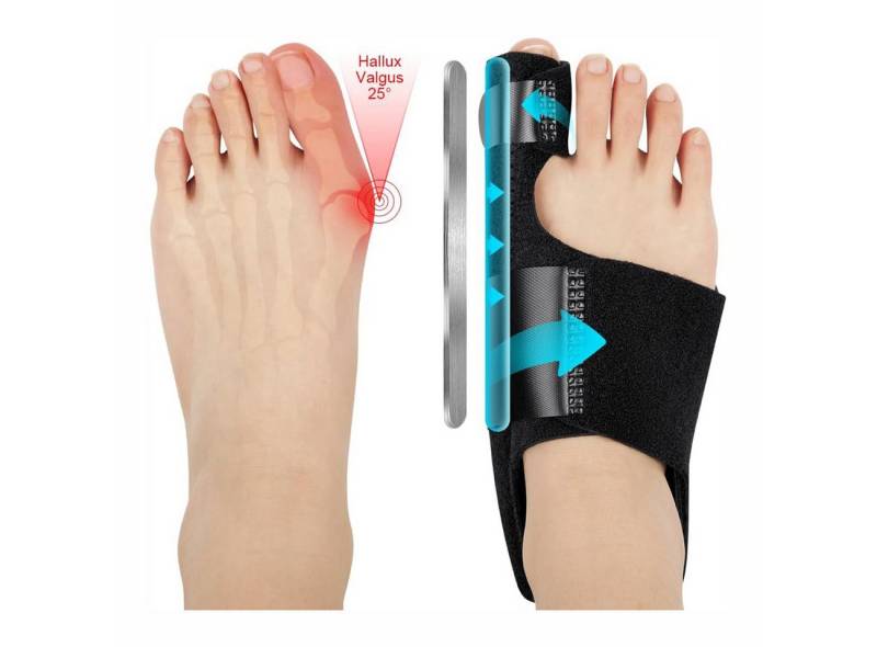 Fitgenics Hallux-Bandage 2x Hallux Valgus Korrektur Schiene,Korrektur Bandage, Unisex, Aluminium-Stützdesign von Fitgenics