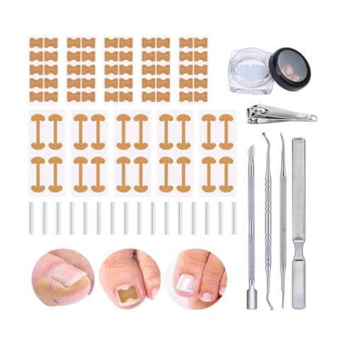 Ingrown Toenail Corrector Set with Correction Strips & Toenail Lifter & File,Professional Pedicure Tools Kit for Ingrown or Curved Toenails,Curved Toenails Corrector Patch (1 set) von Generisch