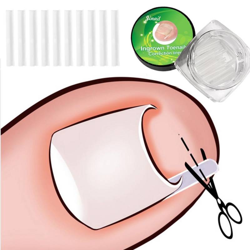 10 stücke Zehennagel Korrektur Werkzeug Zehennagel Behandlung Elastische Patch Aufkleber Richt Clip Klammer Pediküre Werkzeug von Joom DACH
