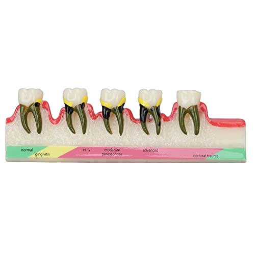 NSXAYIWE Dentalmodell, Keramik-Transparentkonstruktion, Oral-Display-Modell, Zahnmodell, Parodontalmodelle Zum Lehren Und Üben von NSXAYIWE