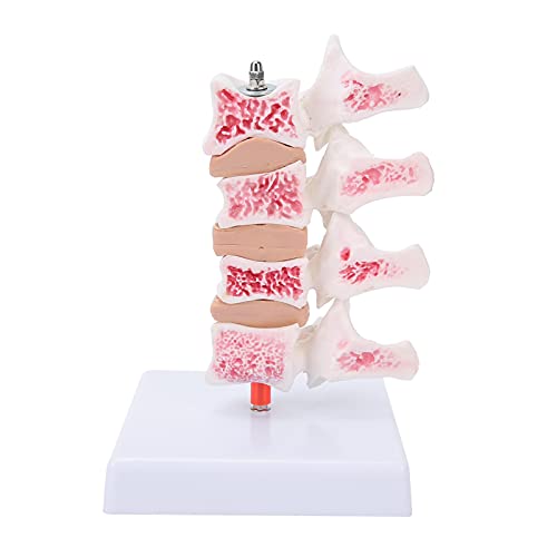 NSXAYIWE Wirbelsäulenmodell, Osteoporosemodell aus PVC-Material, Anatomisches Modell Der Menschlichen Wirbelsäule Für Lehrdemonstrationen von NSXAYIWE