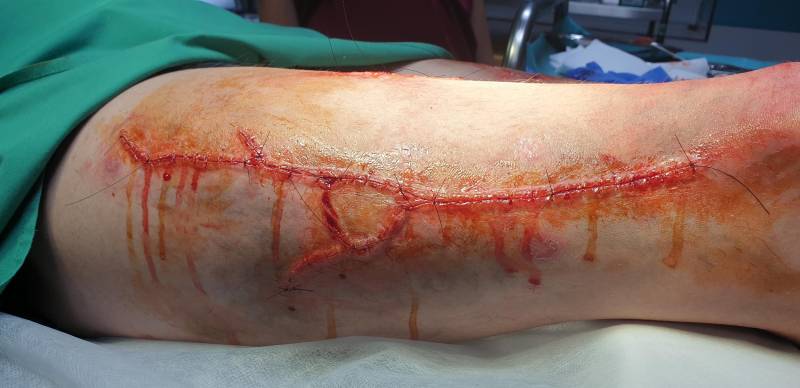 Vernähte Narbe - Ummantelte Silikonprothetik von Satyreffects