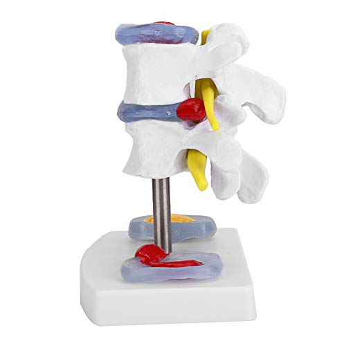 Human Anatomical Lumbal Disc Herniation Model Human Spine School Training Supplies Ausgezeichnete Möglichkeit Zur Demonstration der Disc von Sonew